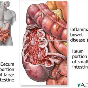 Can Ibs Cause Nausea - A Brief Overview Of Irritable Bowel Syndrome